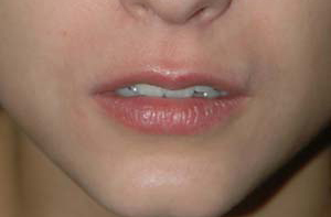 Lip Augmentation - Patient 3 - Before